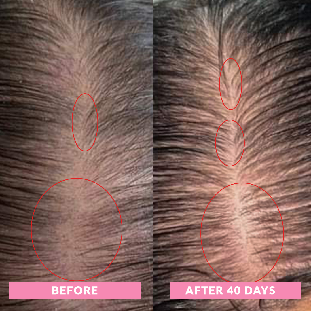 10 Before-After-Daily-Hairloss-supplement